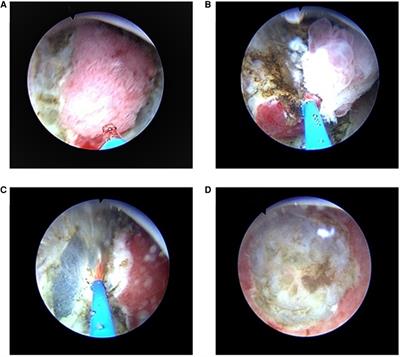 Long-term effect of transurethral partial cystectomy with a 2-micrometer continuous-wave laser for non-muscle-invasive bladder cancer